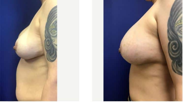 Breast Implant Removal photo 6