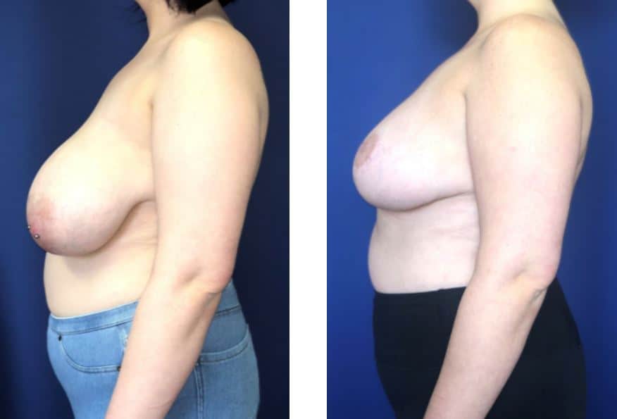 Breast-Reduction-Before-After-Wellesley-Dr-Markarian-Plastic-Surgery-of-Boston (4)