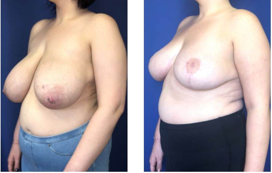 Breast-Reduction-Before-After-Wellesley-Dr-Markarian-Plastic-Surgery-of-Boston (6)