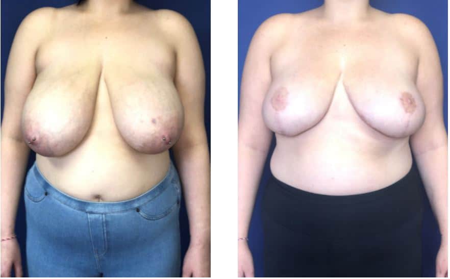 Breast-Reduction-Before-After-Wellesley-Dr-Markarian-Plastic-Surgery-of-Boston (8)