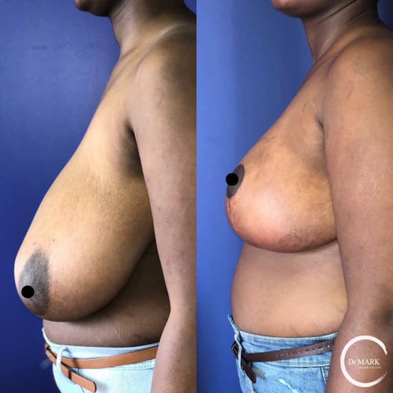 Breast Reduction photo 1