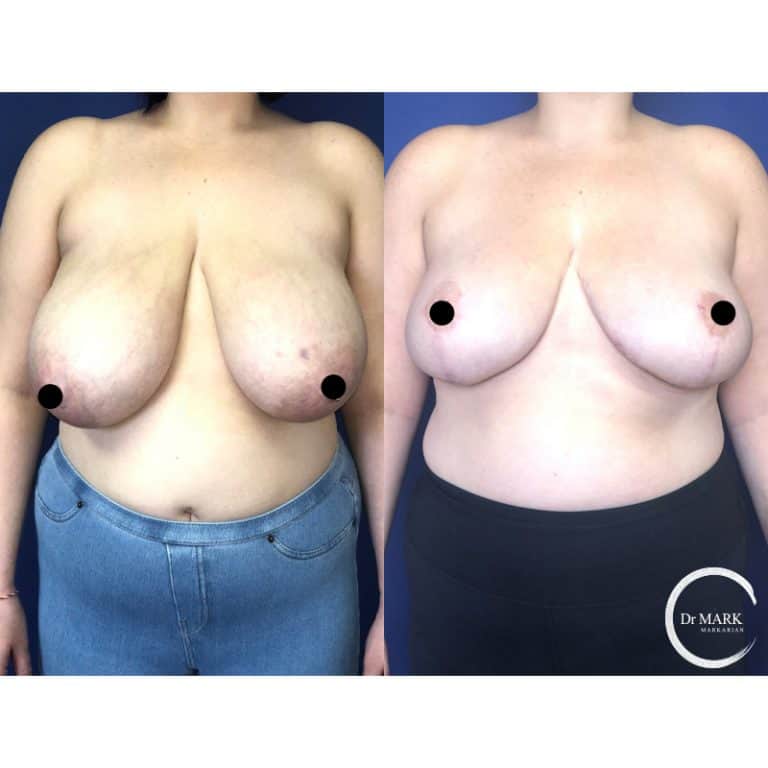 Breast Reduction photo 3