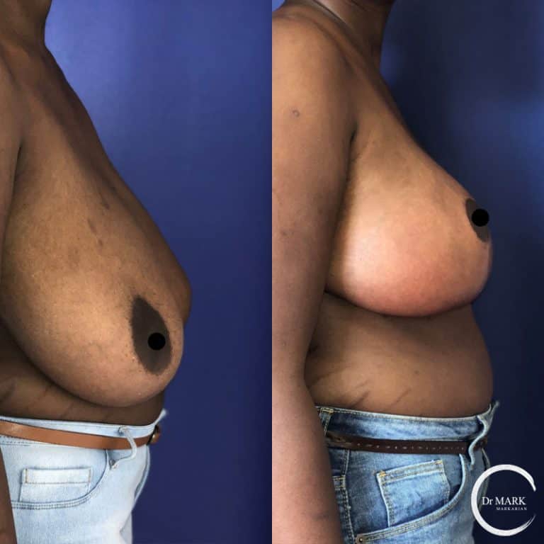 Breast Reduction photo 2