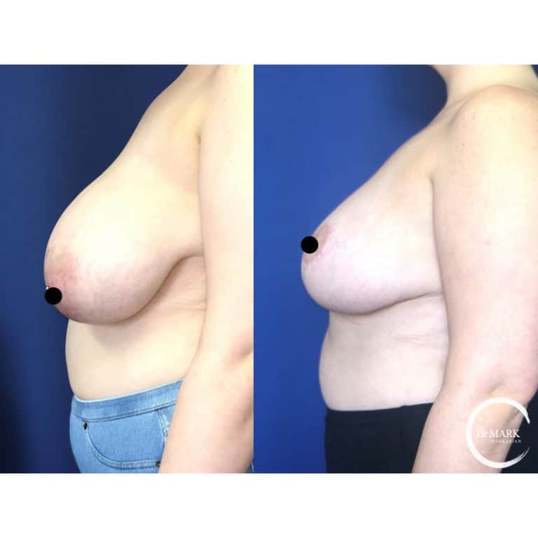 Breast Reduction photo 5