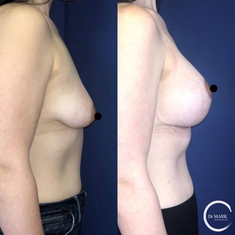 Breast Lift photo 4