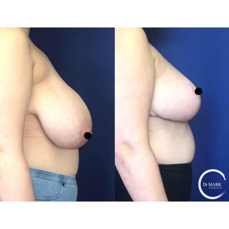 Breast Reduction photo 6