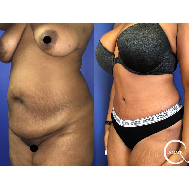 How Long Do You Have to Wait to Have a Tummy Tuck After a BBL? - Millennial  Plastic Surgery