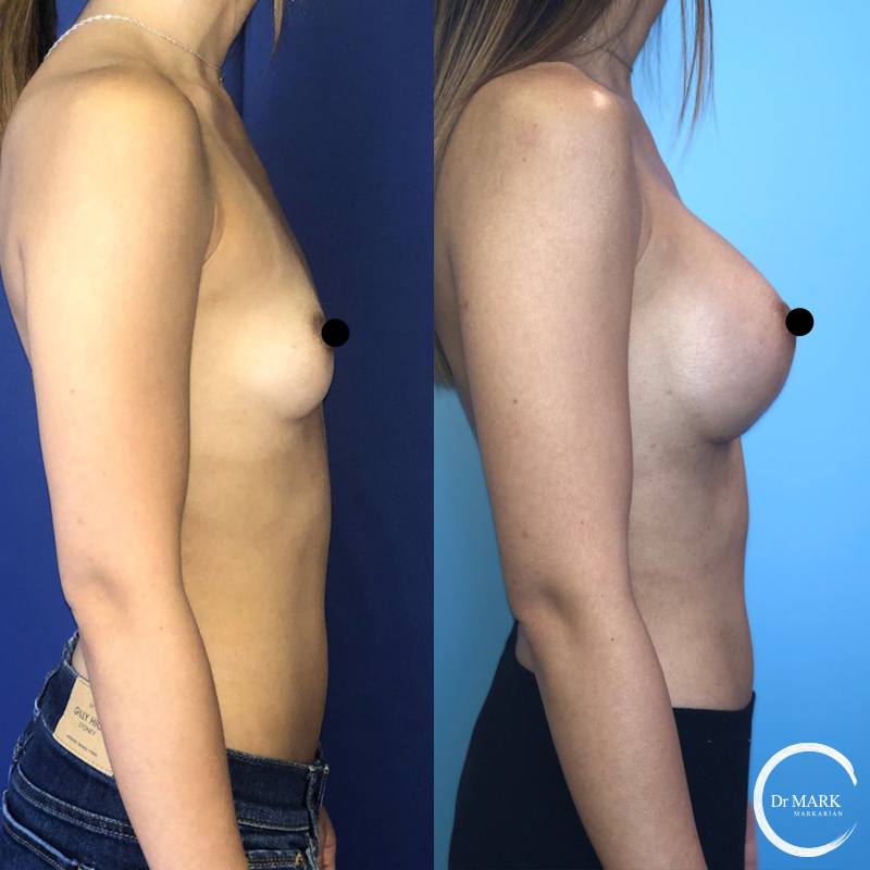 Breast Augmentation North Shore Before and After