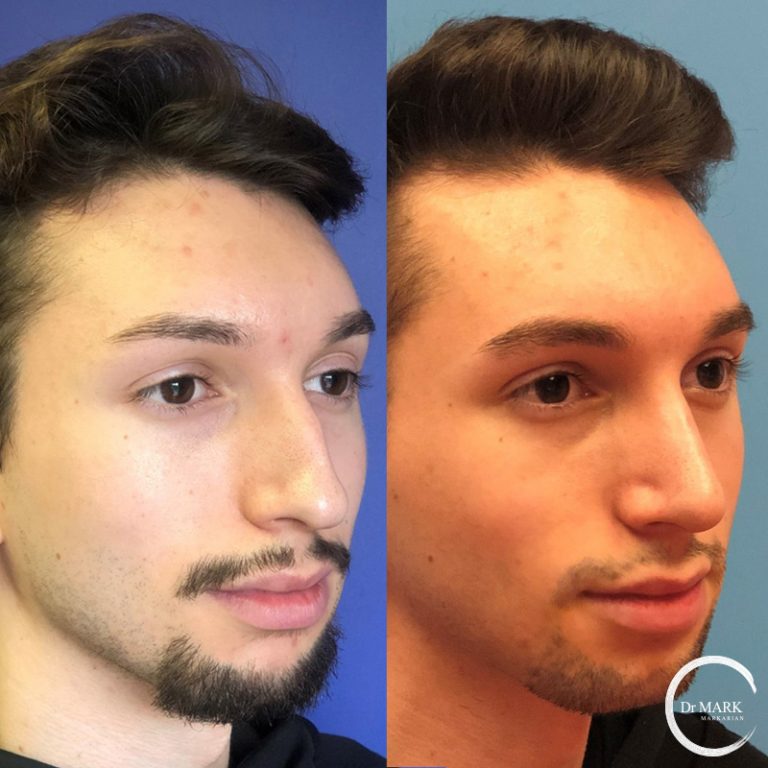 RhinoplastyBeforeAndAfter (1)