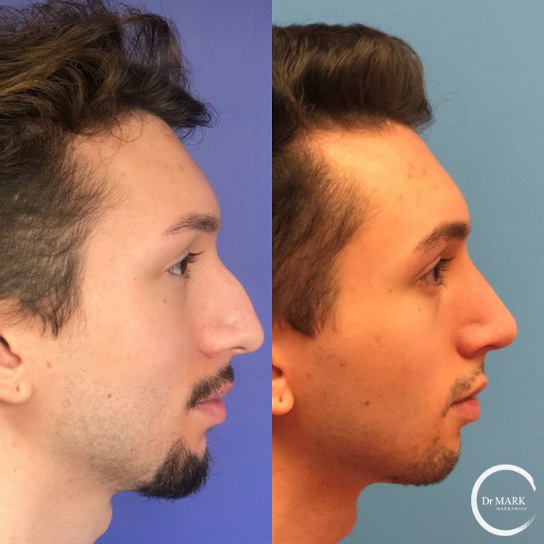 RhinoplastyBeforeAndAfter (2)