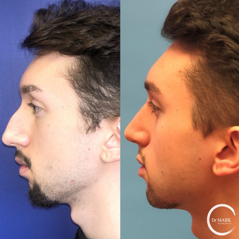 RhinoplastyBeforeAndAfter