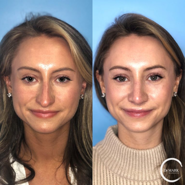 Rhinoplasty_Before&After_AP