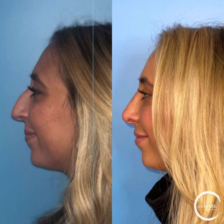 Rhinoplasty_BeforeAfter_LeftLateral-1