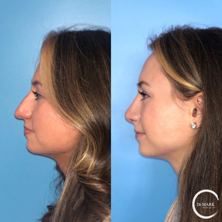 Rhinoplasty_Before&After_LeftLateral