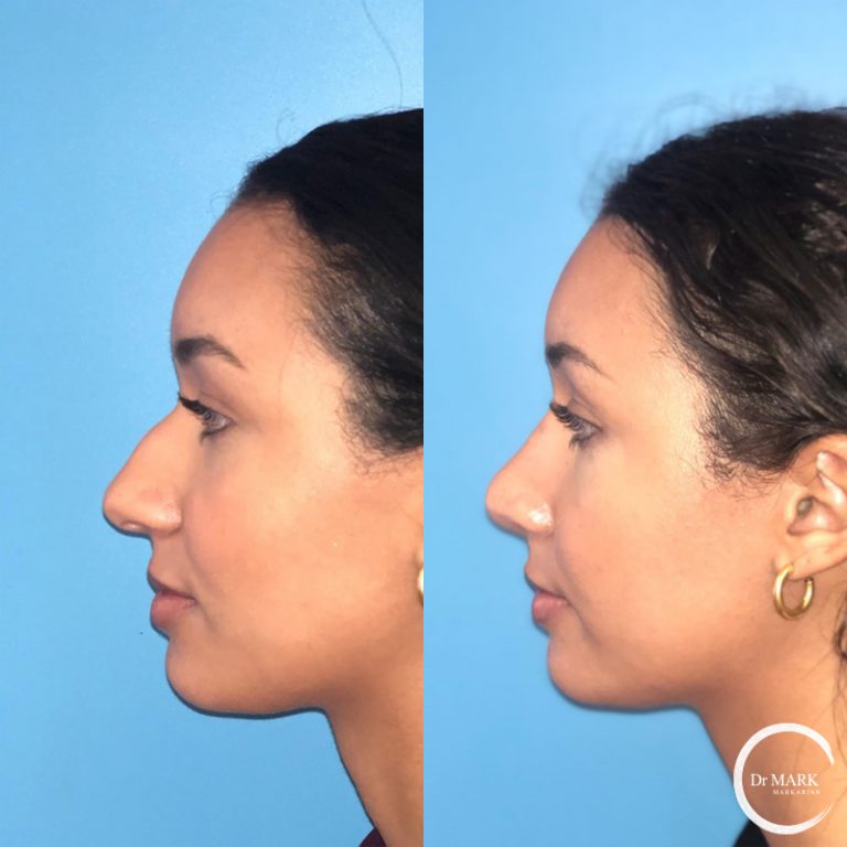 Rhinoplasty_Before&After_LeftLateral