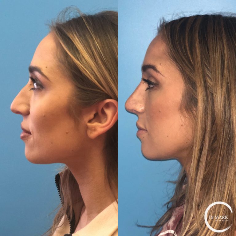 Rhinoplasty_Before&After_LeftLateral