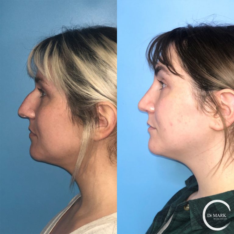 Rhinoplasty_Before&After_LeftLateral