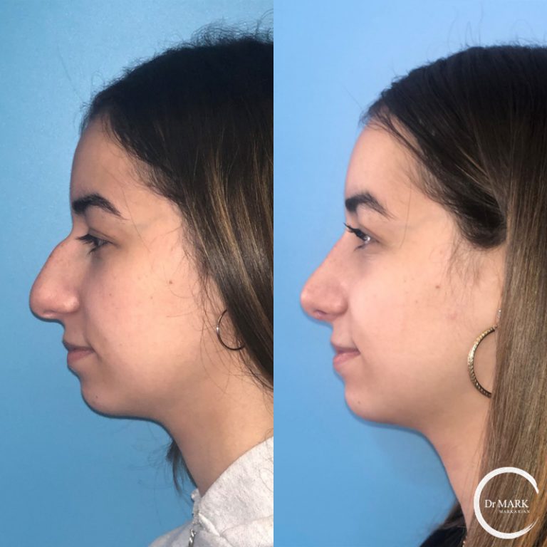 Rhinoplasty_BeforeAfter_LeftLateral