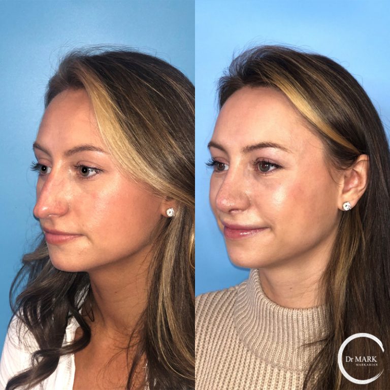Rhinoplasty_Before&After_LeftOblique