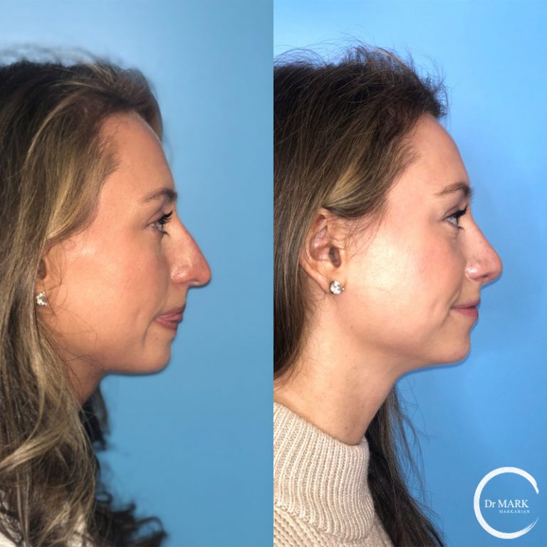 Rhinoplasty_Before&After_RightLateral