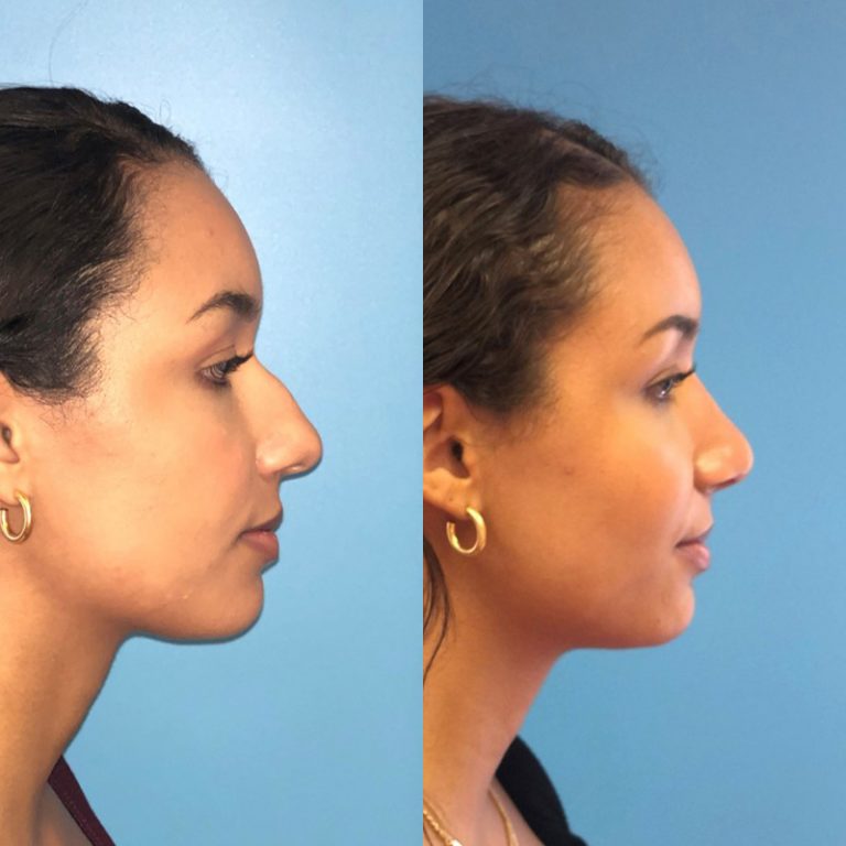 Rhinoplasty_Before&After_RightLateral