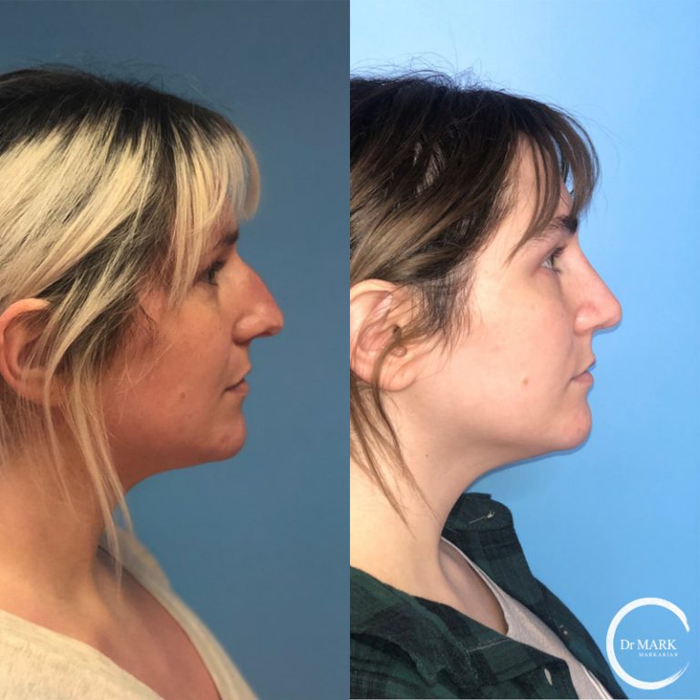Rhinoplasty_Before&After_RightLateral