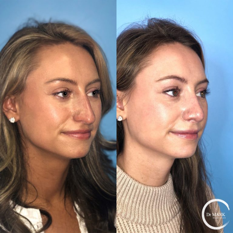 Rhinoplasty_Before&After_RightOblique