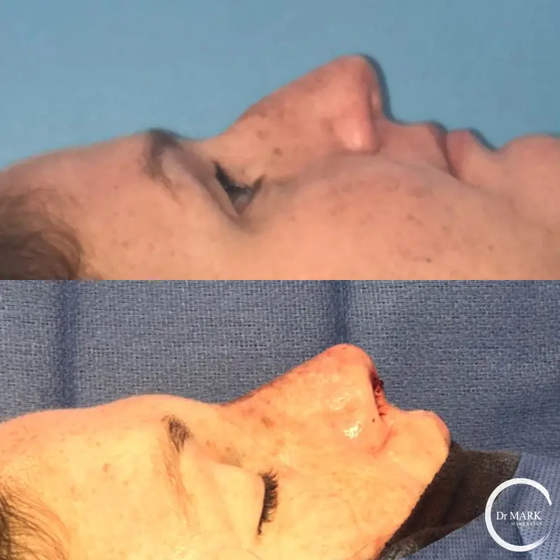 Female Rhinoplasty patient result 80