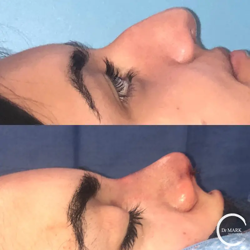 Female Rhinoplasty patient result 81