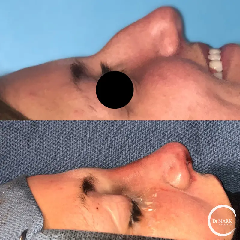 Female Rhinoplasty patient result 79