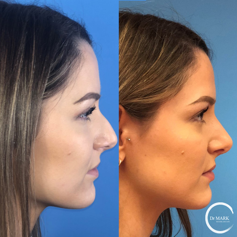 Nose Job Hartford Connecticut Dr Markarian