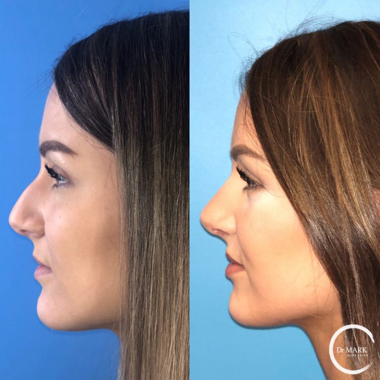Nose Job B+A Cape Cod Patient 1 (2)