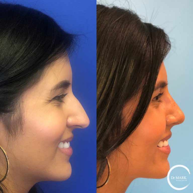 Nose Job B+A Cape Cod Patient 2 (1)