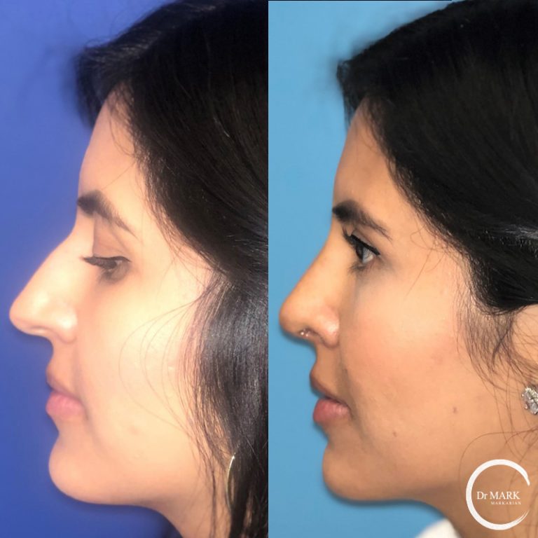Nose Job B+A Cape Cod Patient 2 (2)