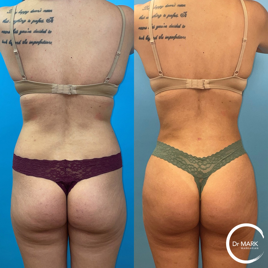 https://plasticsurgeryofboston.com/wp-content/uploads/2022/02/DM-for-RS-mo-Back-view.jpg