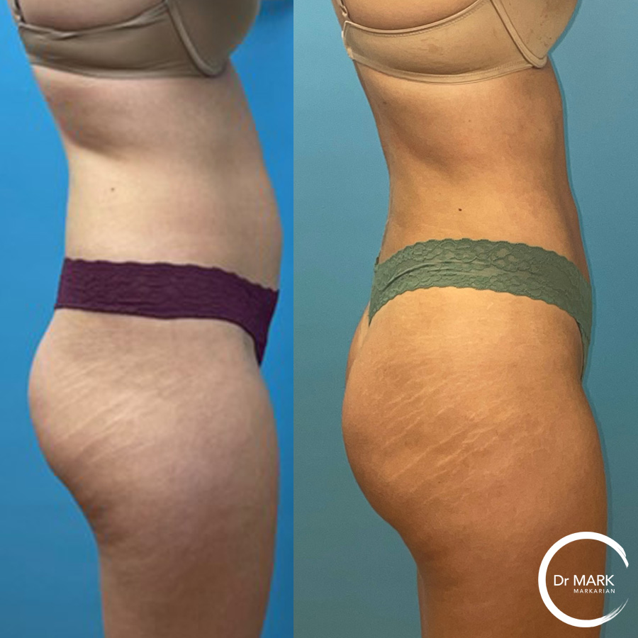 Can You Be Too Skinny For A BBL? - Atlanta Liposuction Specialty