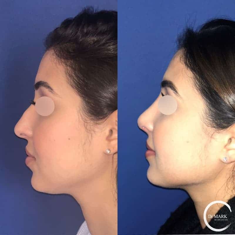 What is Upturned Nose Rhinoplasy?