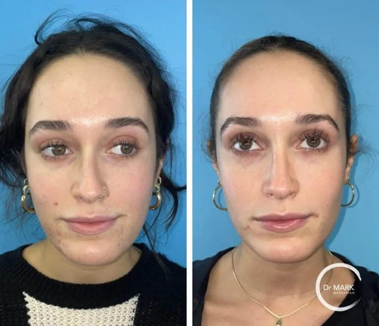 Patient 2, 6 months post-op, view 1