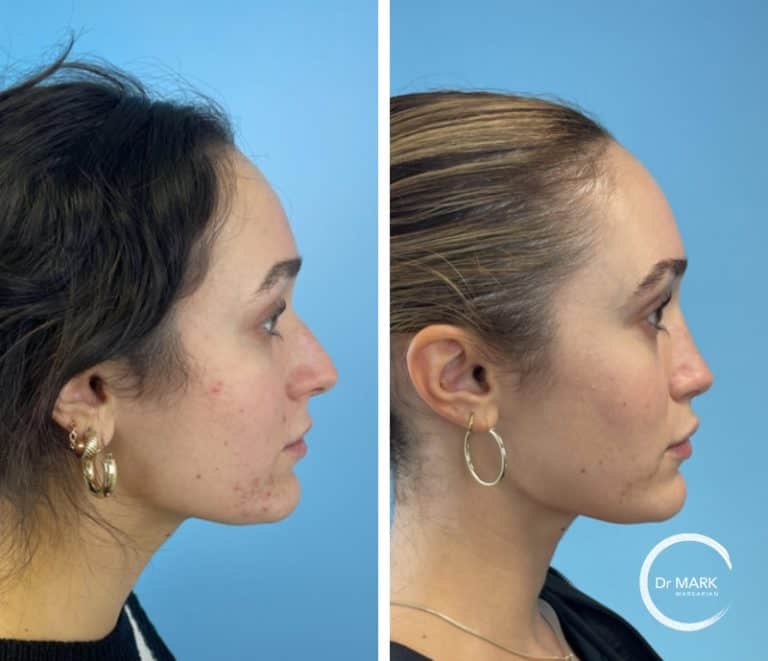 rhinoplasty-2 (1)