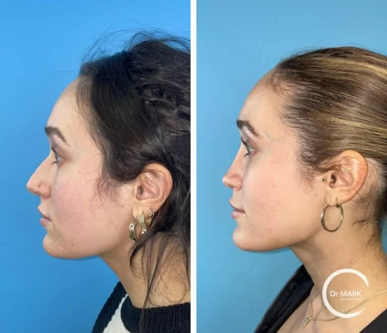 Patient 2, 6 months post-op, view 2