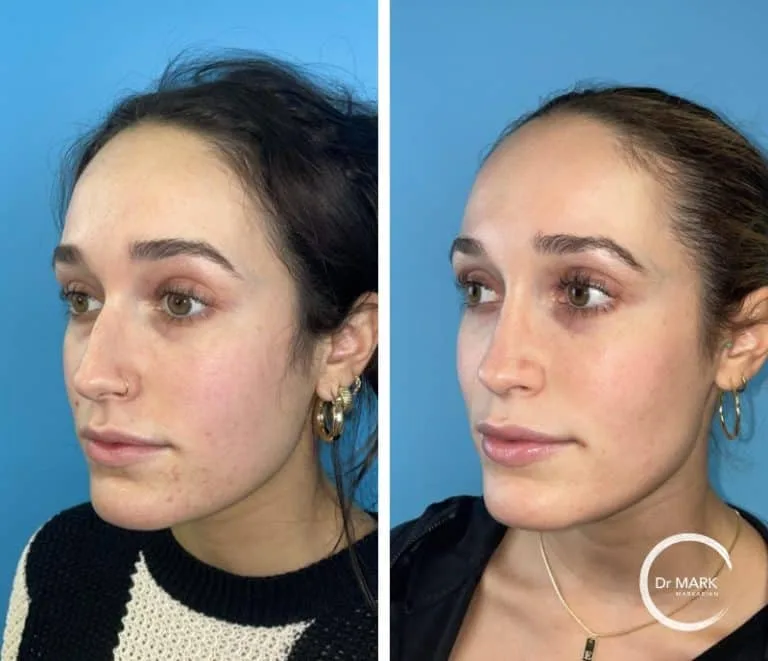 Patient 2, 6 months post-op, view 4