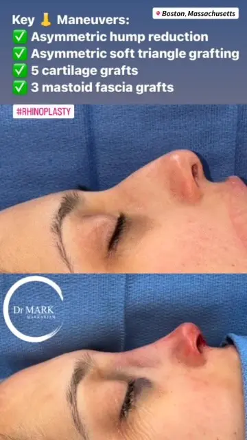 Female Rhinoplasty patient result 67