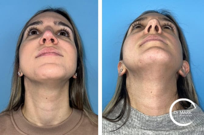 IG 6mo worms eye (1)