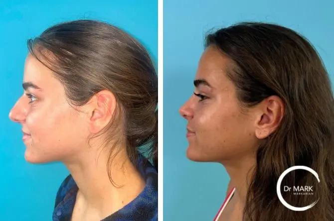 10 months after rhinoplasty, left lateral smiling