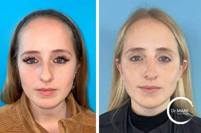 14 months after rhinoplasty, AP view