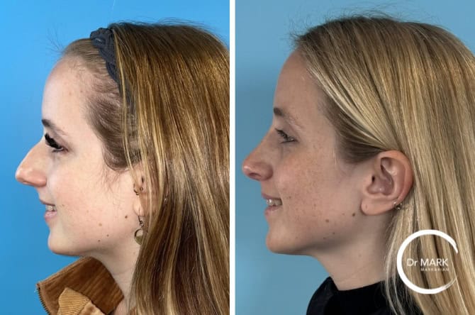 GS for RS left lateral smiling (1)