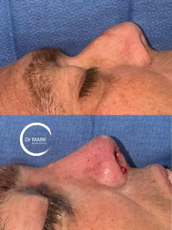 Female Rhinoplasty patient result 78