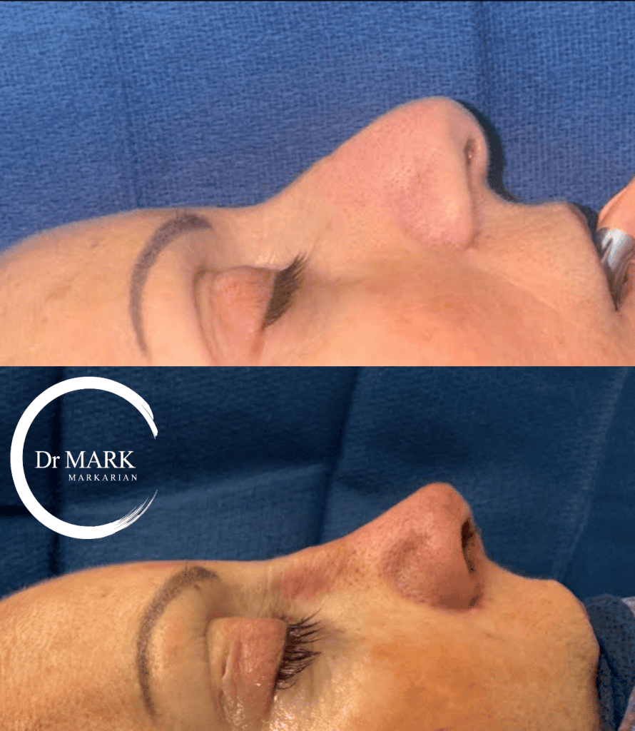Female Rhinoplasty patient result 54