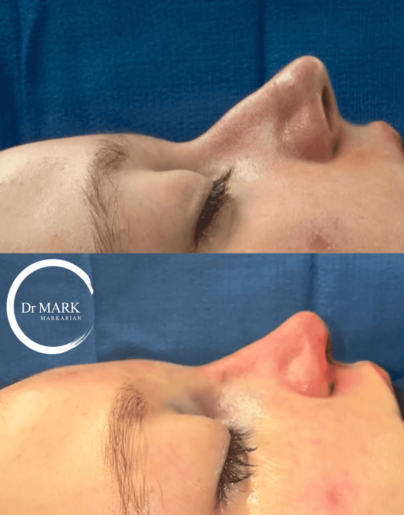Female Rhinoplasty patient result 55
