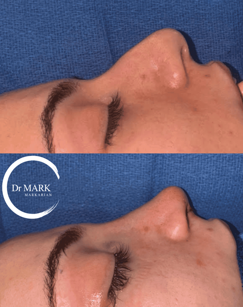 Female Rhinoplasty patient result 57